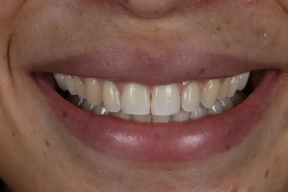 Composite Bonding before treatment, case 5