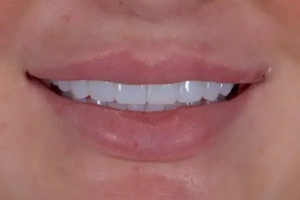 Composite Bonding after treatment, case 6