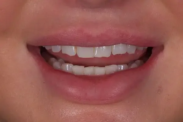 Composite Bonding before treatment, case 6