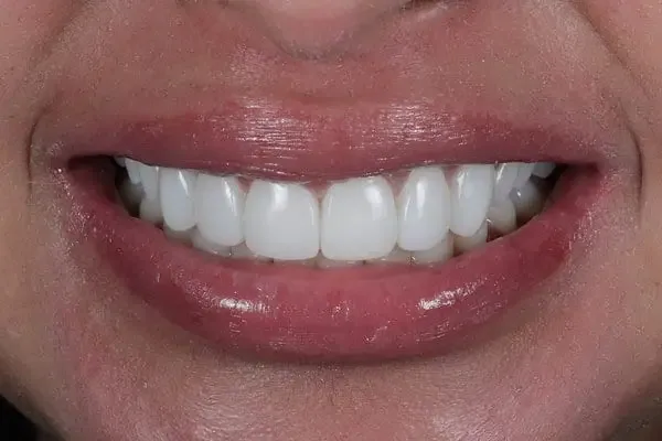 Composite Bonding after treatment, case 7