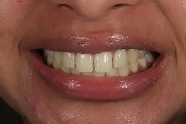 Composite Bonding before treatment, case 7