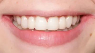 Dental Bridges after treatment, case 1