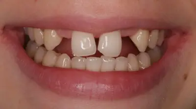 Dental Bridges before treatment, case 1