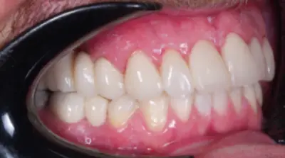 Dental Bridges after treatment, case 2