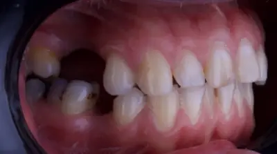 Dental Bridges before treatment, case 2