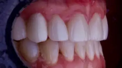 Dental Bridges after treatment, case 3