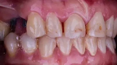Dental Bridges before treatment, case 3