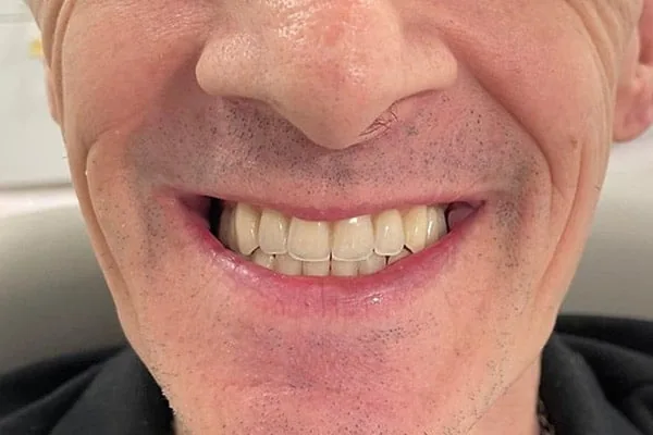 Dentures after treatment, case 1