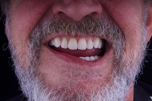 Close-up of a patient’s smile after denture treatment at Vitruvian Dental Studio