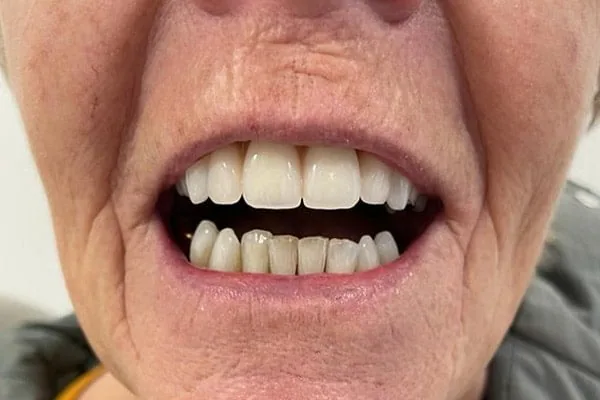 Dentures after treatment, case 3