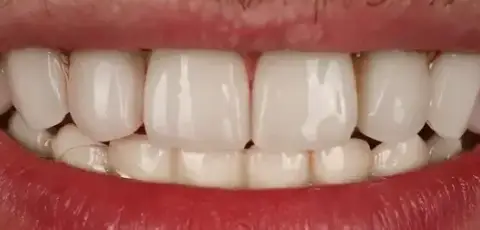 Dental Implants after treatment, case 1