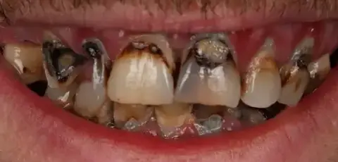 Dental Implants before treatment, case 1
