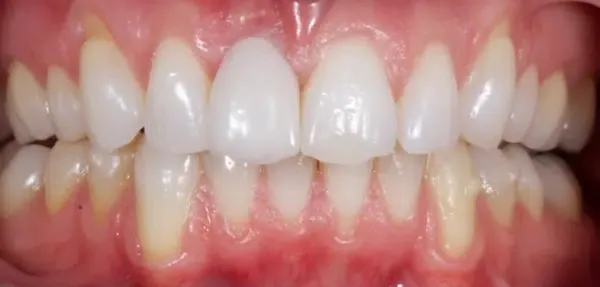 Dental Implants after treatment, case 2