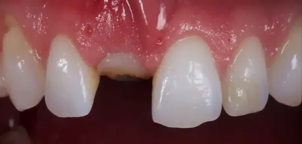 Dental Implants before treatment, case 2