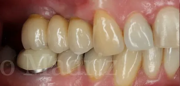 Dental Implants after treatment, case 3