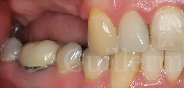 Dental Implants before treatment, case 3