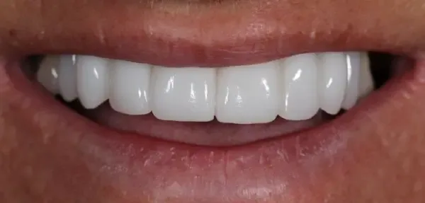 Dental Implants after treatment, case 4