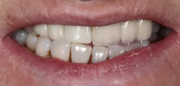Dental Implants before treatment, case 4