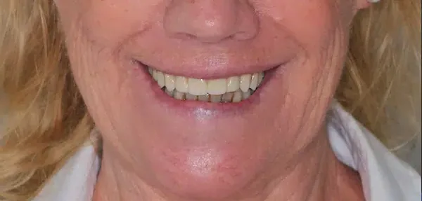 Dental Implants after treatment, case 5