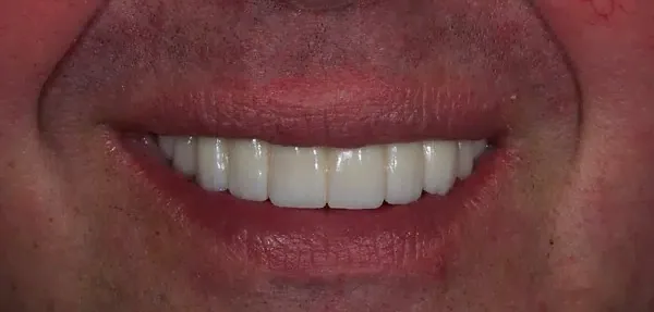 Dental Implants after treatment, case 6