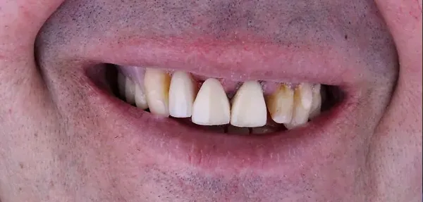 Dental Implants before treatment, case 6