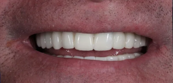 Dental Implants after treatment, case 7