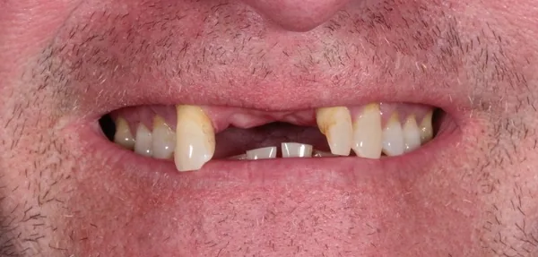 Dental Implants before treatment, case 7
