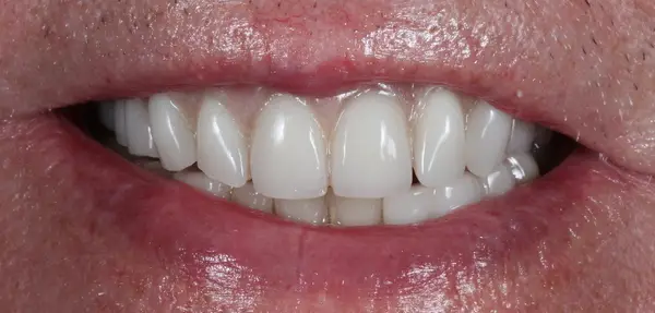 Dental Implants after treatment, case 8