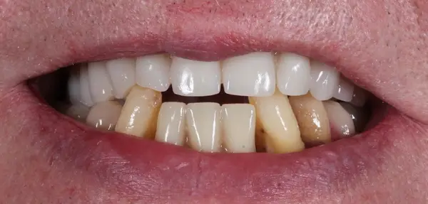 Dental Implants before treatment, case 8