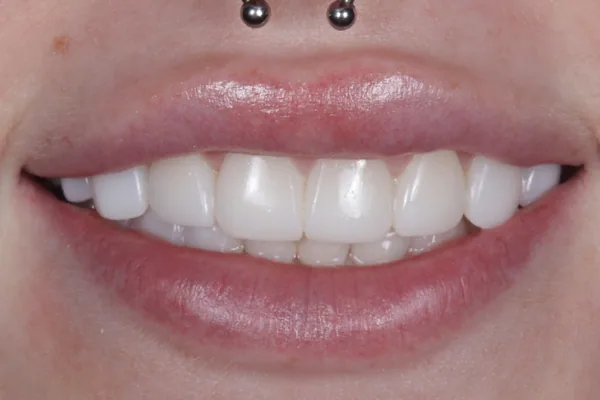 Clear Aligners after treatment, case 1