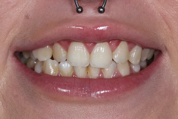 Clear Aligners before treatment, case 1