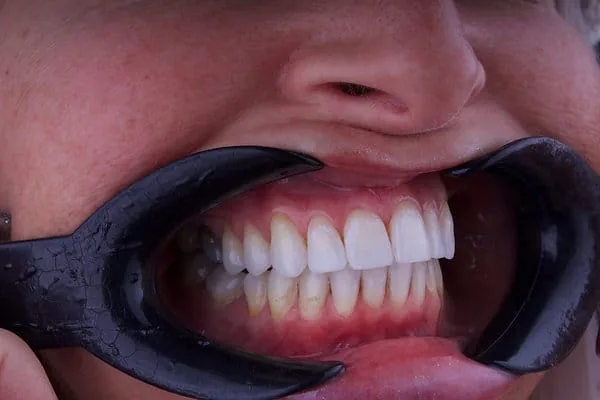 Clear Aligners after treatment, case 3