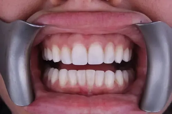 Clear Aligners after treatment, case 5