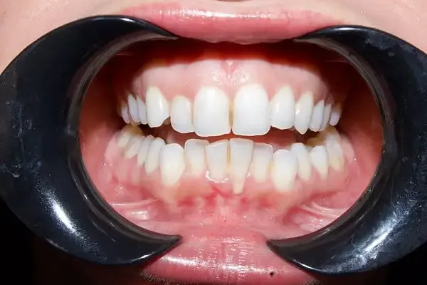 Clear Aligners before treatment, case 5