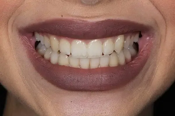 Clear Aligners after treatment, case 6