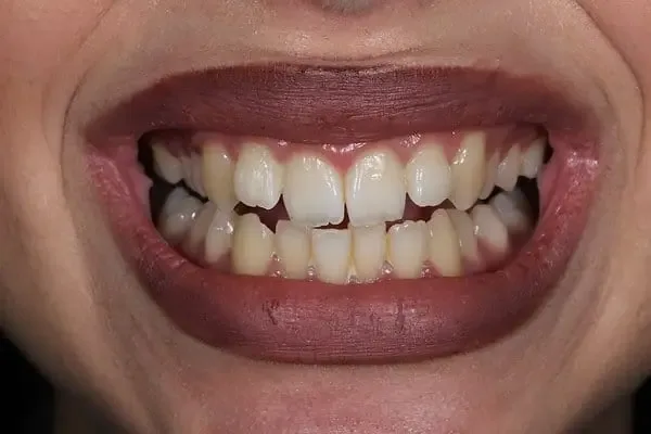 Clear Aligners before treatment, case 6