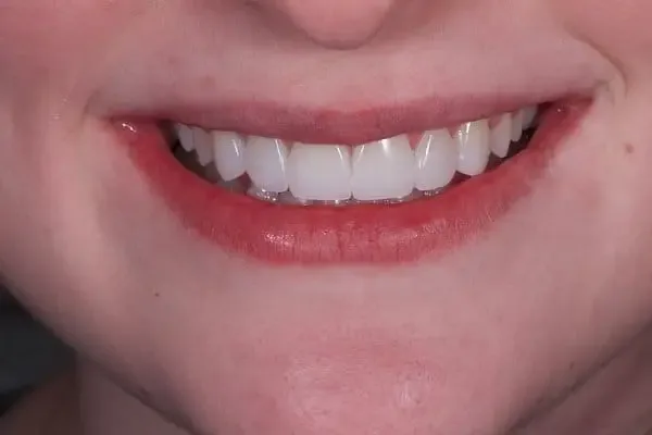 Clear Aligners after treatment, case 7