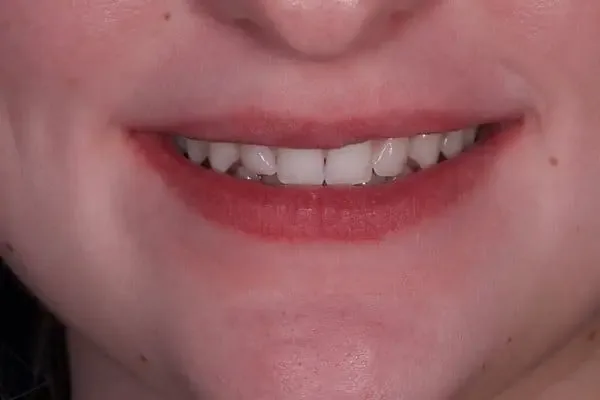 Clear Aligners before treatment, case 7