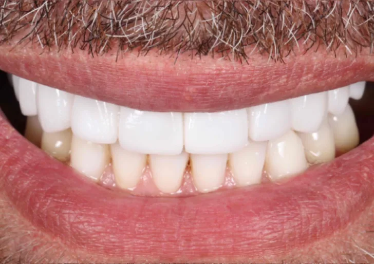Porcelain Veneers after treatment, case 2