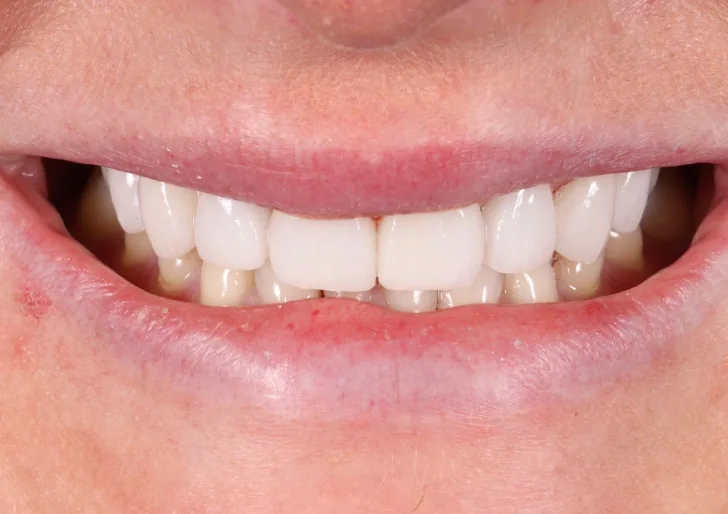 Porcelain Veneers after treatment, case 4