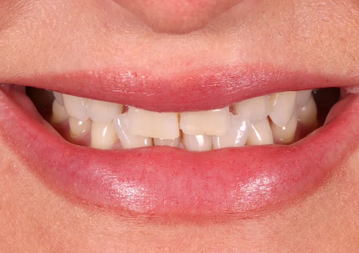 Porcelain Veneers before treatment, case 4