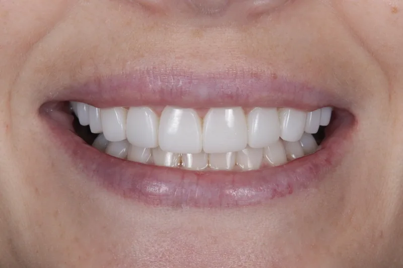 Porcelain Veneers after treatment, case 5