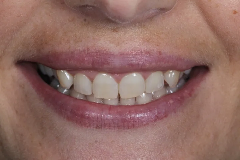 Porcelain Veneers before treatment, case 5