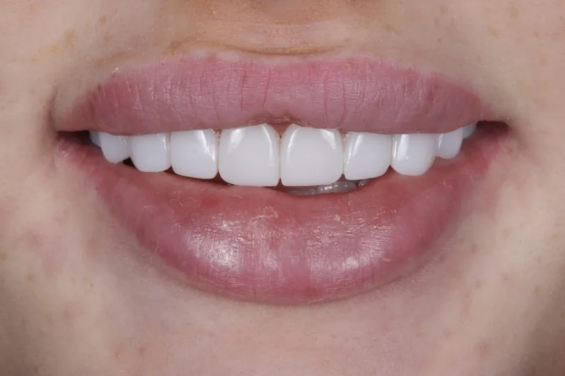 Porcelain Veneers after treatment, case 6