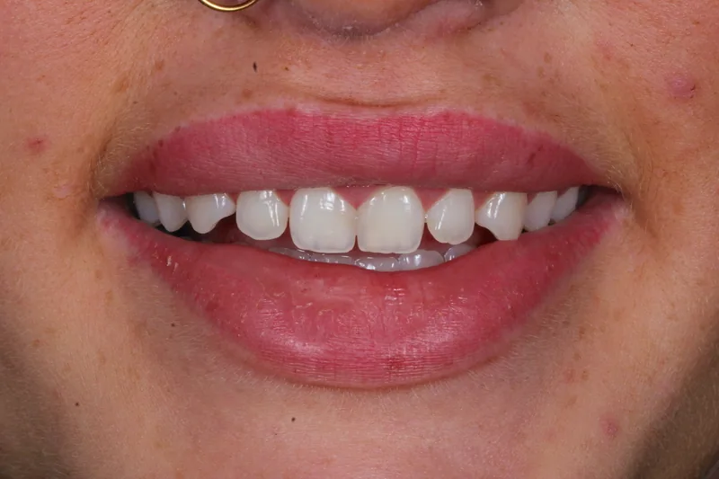 Porcelain Veneers before treatment, case 6