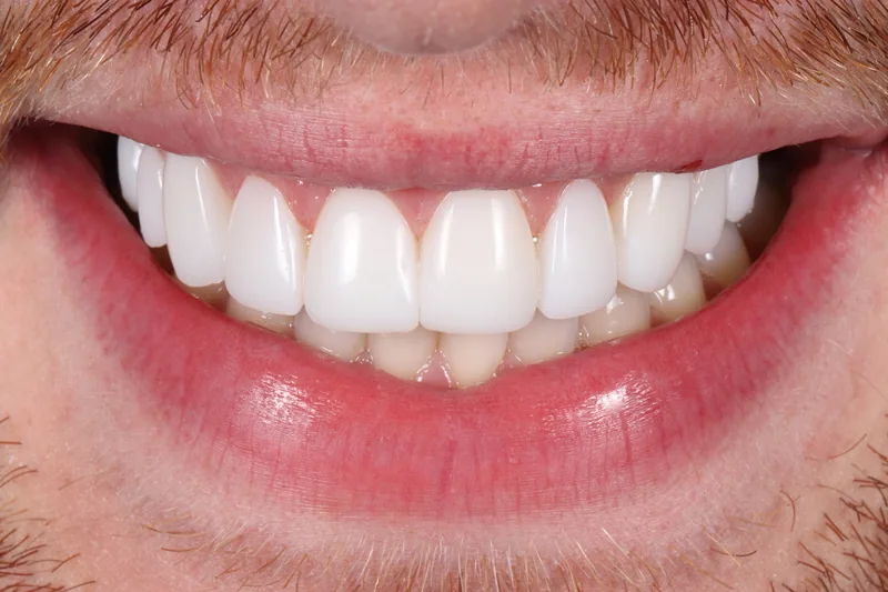 Porcelain Veneers after treatment, case 7