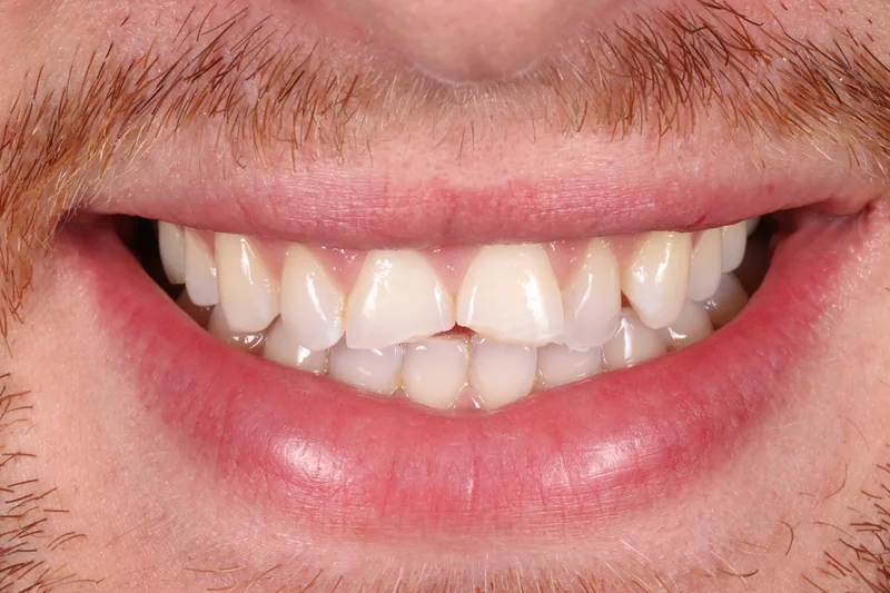 Porcelain Veneers before treatment, case 7