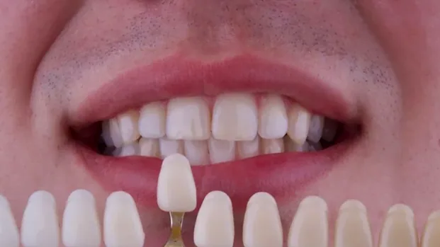 Teeth Whitening before treatment, case 1