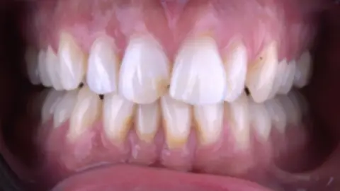 Teeth Whitening after treatment, case 2