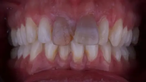 Teeth Whitening before treatment, case 2